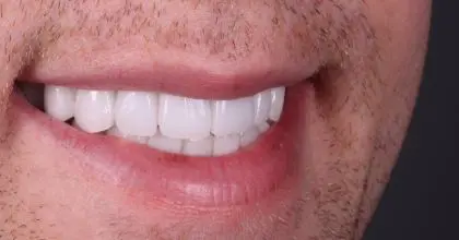 AT after replacement crowns, full mouth rehabilitation