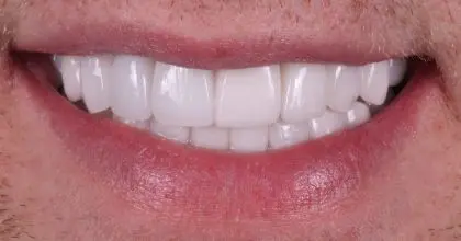 AT after replacement crowns, full mouth rehabilitation