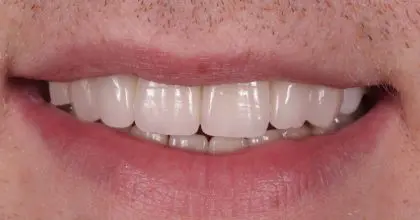AT before replacement crowns, full mouth rehabilitation