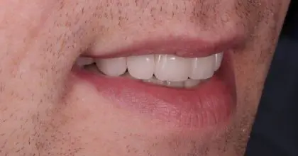 AT before , side smile, replacement crowns, full mouth rehabilitation