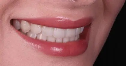 CC. After invisalign, whitening and bonding