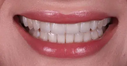 CC. After invisalign, whitening and bonding