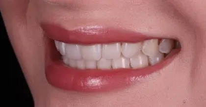 CC. After invisalign, whitening and bonding side
