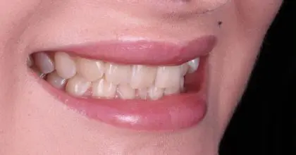 CC. Before invisalign, whitening and bonding