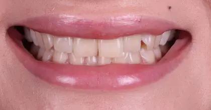 CC. Before invisalign, whitening and bonding