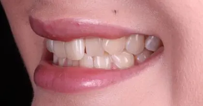 CC. Before invisalign, whitening and bonding side