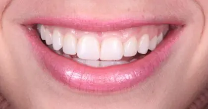 CK, after, invisalign, whitening & bonding