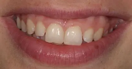 CK, before, invisalign, whitening & bonding