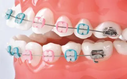 Ceramic Braces