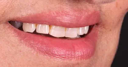 D.K Before whitening, veneers and crowns