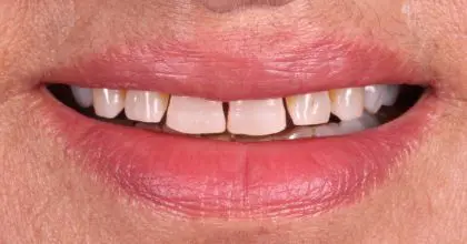 D.K Before whitening, veneers and crowns