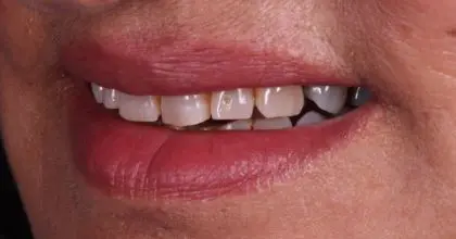 D.K Before whitening, veneers and crowns