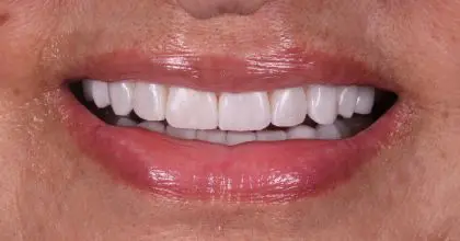D.K after whitening, veneers and crowns