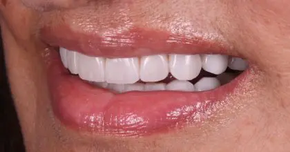 D.K after whitening, veneers and crowns