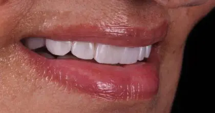D.K after whitening, veneers and crowns