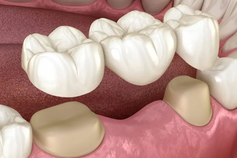 Dental Bridges Kent