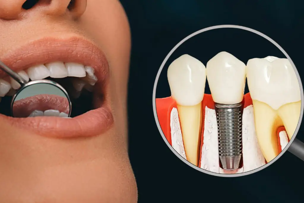 Dental Implants Wimbledon