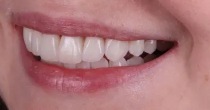 EE. After. Side left Whitening & veneers x7 ( upper 6 , 1 lower)