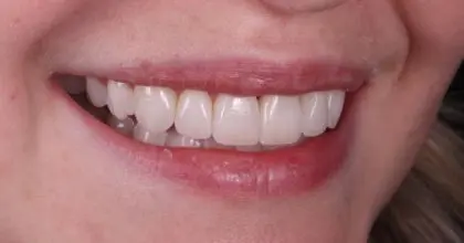 EE. After. Side right, Whitening & veneers x7 ( upper 6 , 1 lower)