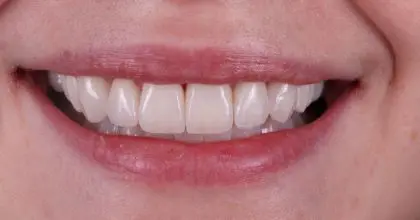 EE. After. Whitening & veneers x7 (upper 6, 1 lower)