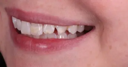 EE. Before. Side left Whitening & veneers x7 ( upper 6 , 1 lower)
