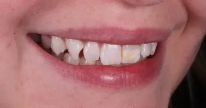 EE. Before. Side right, Whitening & veneers x7 ( upper 6 , 1 lower)