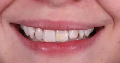 EE. Before. Whitening & veneers x7 (upper 6, 1 lower)