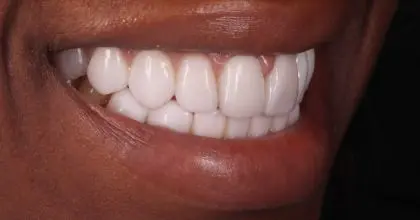 ET, AFTER, whitening & veneers