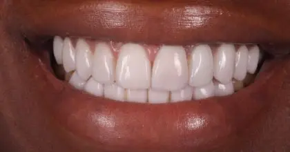 ET, AFTER, whitening & veneers
