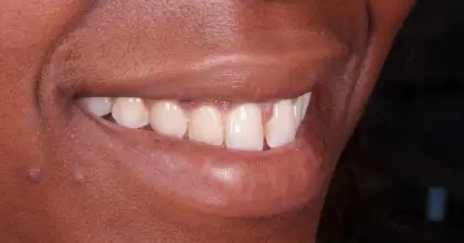 ET, Before veneers