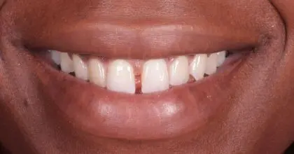 ET, Before veneers