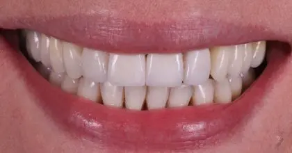 HT After, Invisalign, whitening and veneers