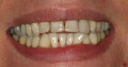 HT, Before, Invisalign, whitening and veneers
