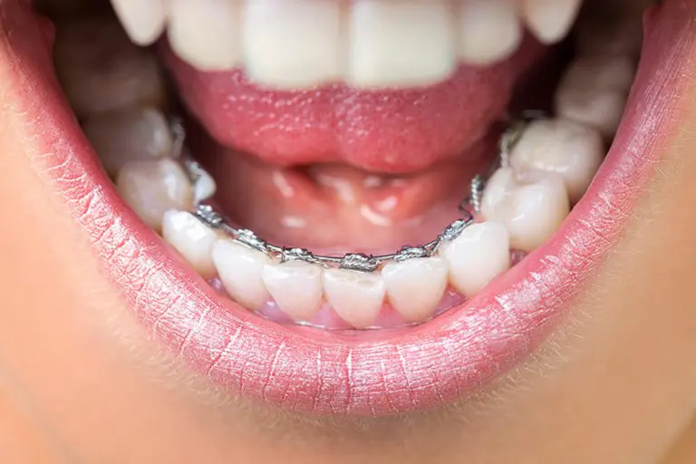 Incognito Lingual Braces Kent