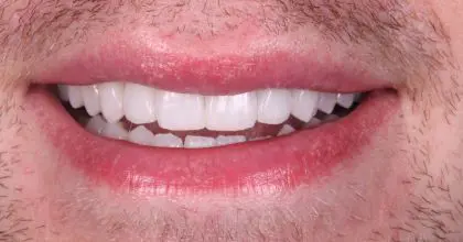 JC, AFTER, whitening & veneer X6