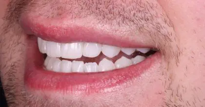 JC. After , smiling left Enlighten & 6 upper veneers