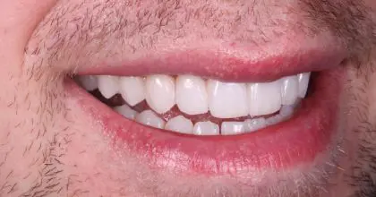 JC. After. Enlighten & 6 upper veneers
