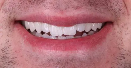 JC. Before. Smiling. Enlighten & 6 upper veneers