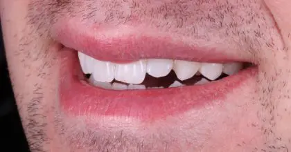 JC. Before. Side smiling . Enlighten & 6 upper veneers