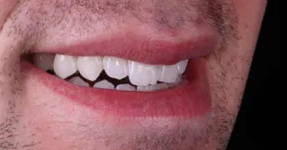 JC. Before. Side smiling. Enlighten & 6 upper veneers