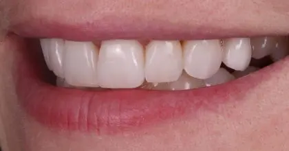 JH after side smiling. whitening & veneers (x8)