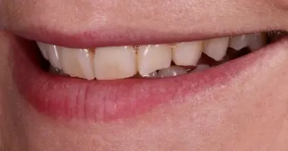 JH before side smile, whitening & veneers (x8)