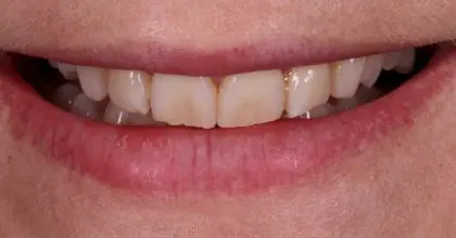 JH before smiling. whitening & veneers (x8)