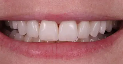 JH whitening & veneers (x8)