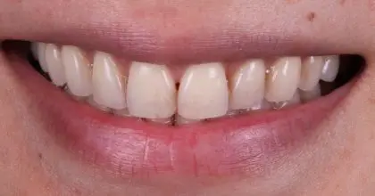 JL, before, smiling, whitening + veneers