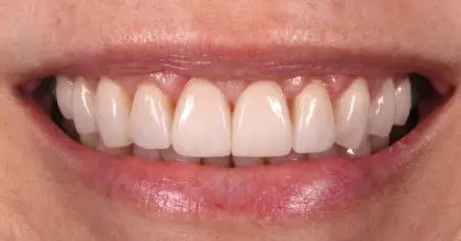 JV, After, crown lengthening, whitening and veneers