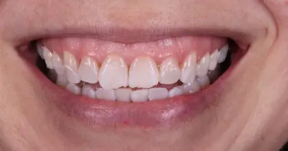 JV, Before, crown lengthening, whitening and veneers 1