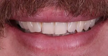 MM. Before, Whitening & veneers