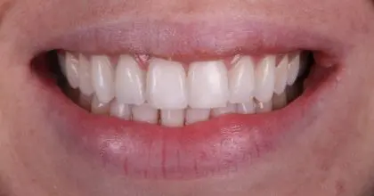 N.A after. Icon & Enlighten whitening