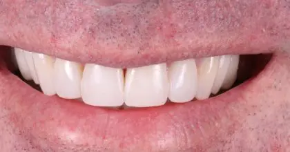 PA. After. invisalign, whitening, & bonding